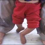 Polio