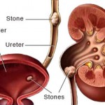 Kidney Stones