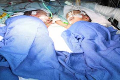 Switzerland: twin sisters joined