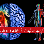 Paralysis Stroke