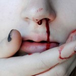 nose-bleeding-may-be-even-more-dangerous2