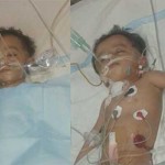 Surgery to separate body connected children in Lahore