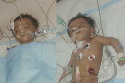 Surgery to separate body connected children in Lahore