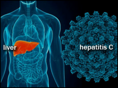 New hepatitis C drug cured 10 million people in the Third World