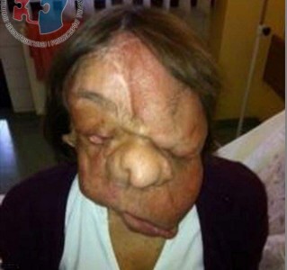 Successful face transplant woman suffering from a mysterious illness