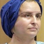 Successful face transplant woman suffering from a mysterious illness
