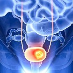 Lack of vitamin D may increase the risk of bladder cancer, research