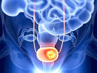 Lack of vitamin D may increase the risk of bladder cancer, research