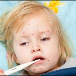 Epidemic of Measles in Balochistan, 5 childrens killed, 45 affected