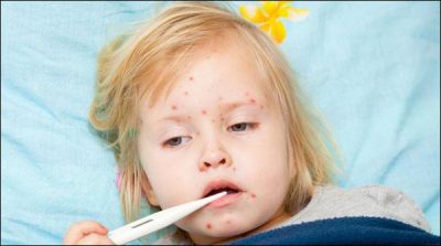 Epidemic of Measles in Balochistan, 5 childrens killed, 45 affected