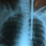 Peru: sink Iron rod was removed from the woman's neck