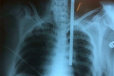 Peru: sink Iron rod was removed from the woman's neck