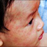 Chaman, kills 2 children die from measles, dozens affected