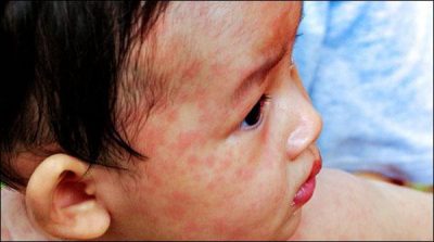 Chaman, kills 2 children die from measles, dozens affected