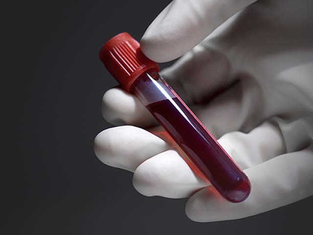 NEW, BLOOD, TEST, DISCOVERED, TO, DEFINE, OTIS,
