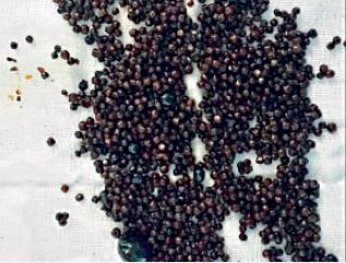 1,600 gallstones removed from woman’s bile duct