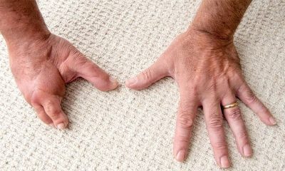 successful, Transplant, of, foot fingers, in, a, hand