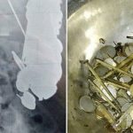 Explore hundreds of coins and nails from the patient's stomach