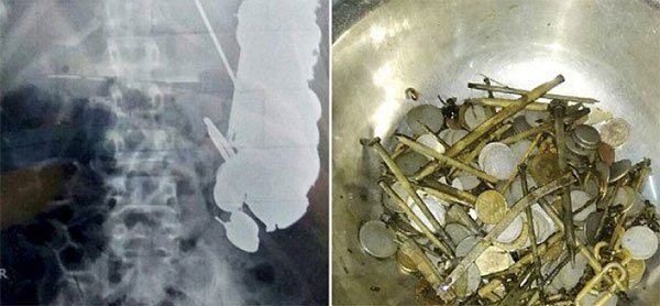 Explore hundreds of coins and nails from the patient's stomach