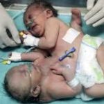 Gaza conjoined twins survive separation surgery