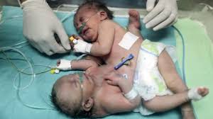 Gaza conjoined twins survive separation surgery