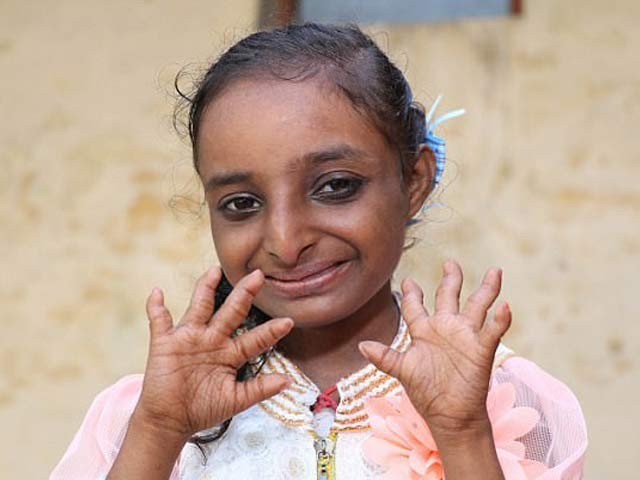 18-year-old girl in India height only two feet 9 inches and habbits like 4-year-old girl