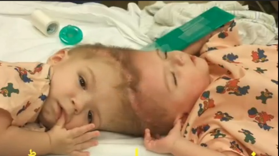 Widow mother appeal for help from high officials for operation of birth twins babies