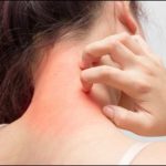 ITCHING, AN, INDIVIDUAL, AND, COLLECTIVE, DISORDER, ALSO