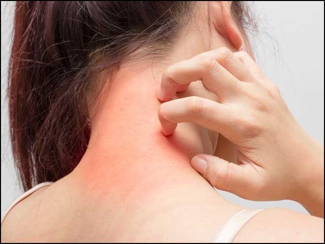 ITCHING, AN, INDIVIDUAL, AND, COLLECTIVE, DISORDER, ALSO