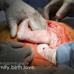 Caesarean section, of, pregnant, women, by, gynaecologists