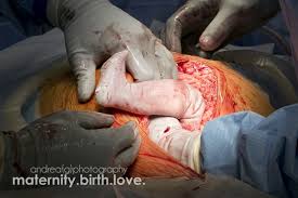 Caesarean section, of, pregnant, women, by, gynaecologists
