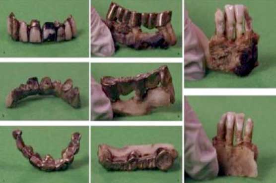 Scientists found Hitler's teeth