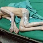 Four children badly burnt from smoke bomb blast in Abbottabad