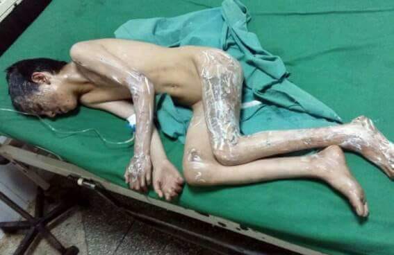 Four children badly burnt from smoke bomb blast in Abbottabad