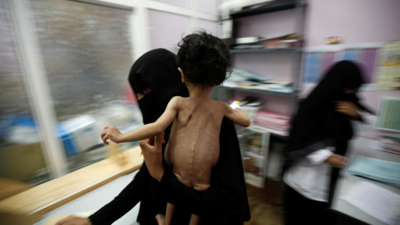 PUBLIC ,OUTCRY ,FORCES, FACEBOOK, TO ,STOP ,BANNING ,PICS, OF, STARVING, YEMENI, GIRL 