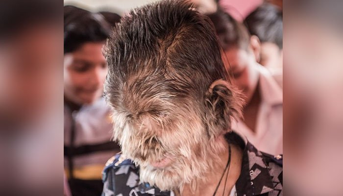 a, child, in, indian, state, madiha pardesh, who, have, full, hair, on, his, mouth