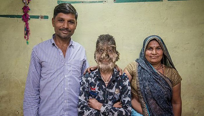 a, child, in, indian, state, madiha pardesh, who, have, full, hair, on, his, mouth