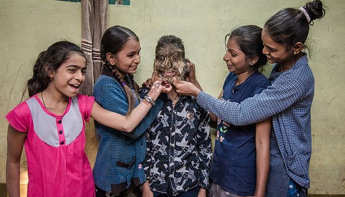 a, child, in, indian, state, madiha pardesh, who, have, full, hair, on, his, mouth